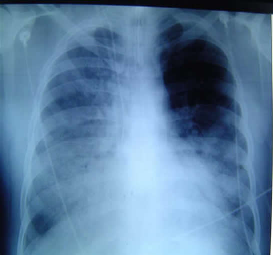 Gripe A y Homeopatia